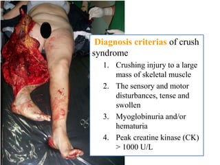 Diagnosis criterias of crush
syndrome
1. Crushing injury to a large
mass of skeletal muscle
2. The sensory and motor
disturbances, tense and
swollen
3. Myoglobinuria and/or
hematuria
4. Peak creatine kinase (CK)
> 1000 U/L
 