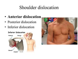 Shoulder dislocation
• Anterior dislocation
• Posterior dislocation
• Inferior dislocation
 