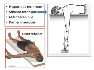 • Hippocratic technique
• Stimson technique
• Milch technique
• Kocher maneuver
 