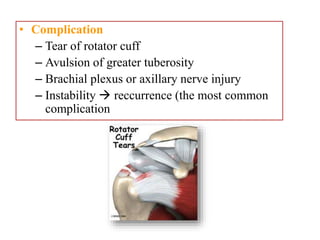 • Complication
– Tear of rotator cuff
– Avulsion of greater tuberosity
– Brachial plexus or axillary nerve injury
– Instability  reccurrence (the most common
complication
 