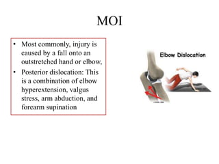 MOI
• Most commonly, injury is
caused by a fall onto an
outstretched hand or elbow,
• Posterior dislocation: This
is a combination of elbow
hyperextension, valgus
stress, arm abduction, and
forearm supination
 