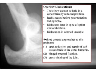 Operative, indications:
• The elbow cannot be held in a
concentrically reduced position,
• Redislocates before postreduction
radiography,
• Dislocates later in spite of splint
immobilization,
• Dislocation is deemed unstable
three general approaches to this
problem:
(1) open reduction and repair of soft
tissues back to the distal humerus,
(2) hinged external fixation,
(3) cross-pinning of the joint.
 