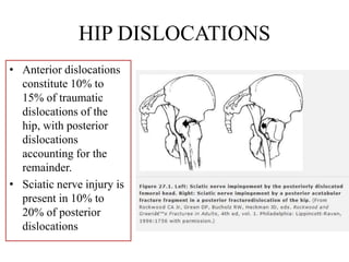 HIP DISLOCATIONS
• Anterior dislocations
constitute 10% to
15% of traumatic
dislocations of the
hip, with posterior
dislocations
accounting for the
remainder.
• Sciatic nerve injury is
present in 10% to
20% of posterior
dislocations
 