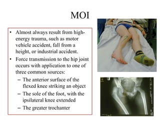 MOI
• Almost always result from high-
energy trauma, such as motor
vehicle accident, fall from a
height, or industrial accident.
• Force transmission to the hip joint
occurs with application to one of
three common sources:
– The anterior surface of the
flexed knee striking an object
– The sole of the foot, with the
ipsilateral knee extended
– The greater trochanter
 