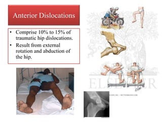 Anterior Dislocations
• Comprise 10% to 15% of
traumatic hip dislocations.
• Result from external
rotation and abduction of
the hip.
 