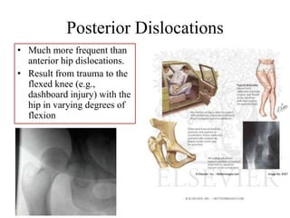 Posterior Dislocations
• Much more frequent than
anterior hip dislocations.
• Result from trauma to the
flexed knee (e.g.,
dashboard injury) with the
hip in varying degrees of
flexion
 