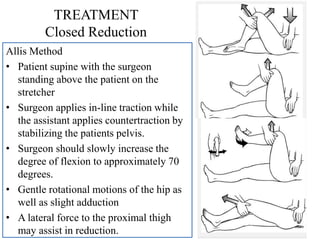 TREATMENT
Closed Reduction
Allis Method
• Patient supine with the surgeon
standing above the patient on the
stretcher
• Surgeon applies in-line traction while
the assistant applies countertraction by
stabilizing the patients pelvis.
• Surgeon should slowly increase the
degree of flexion to approximately 70
degrees.
• Gentle rotational motions of the hip as
well as slight adduction
• A lateral force to the proximal thigh
may assist in reduction.
 
