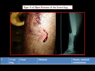 Type~I of Open Fracture of the Lower Leg
I <1 cm
long
Clean Minimal Simple, minimal
comminution
 