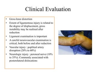 Clinical Evaluation
• Gross knee distortion
• Extent of ligamentous injury is related to
the degree of displacement, gross
instability may be realized after
reduction
• Ligament examination is important
• A careful neurovascular examination is
critical, both before and after reduction
• Vascular injury : popliteal artery
disruption (20% to 60%)
• Neurologic injury : peroneal nerve (10%
to 35%). Commonly associated with
posterolateral dislocations
 