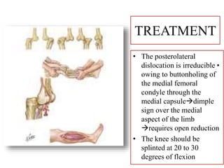 TREATMENT
• The posterolateral
dislocation is irreducible•
owing to buttonholing of
the medial femoral
condyle through the
medial capsuledimple
sign over the medial
aspect of the limb
requires open reduction
• The knee should be
splinted at 20 to 30
degrees of flexion
 