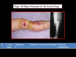 Type~II Open Fracture of the Lower Leg
II >1cm
long
Moderate Moderate, some muscle damage Moderate
comminution
 