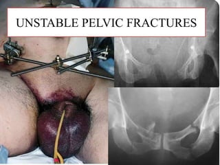 UNSTABLE PELVIC FRACTURES
 