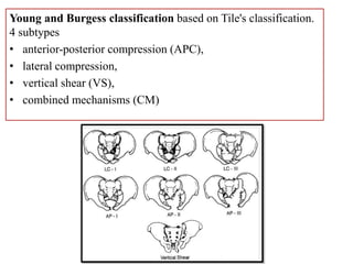 Young and Burgess classification based on Tile's classification.
4 subtypes
• anterior-posterior compression (APC),
• lateral compression,
• vertical shear (VS),
• combined mechanisms (CM)
 
