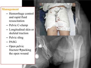 Management
– Hemorrhage control
and rapid fluid
resuscitation
– Pelvic C-clamp
– Longitudinal skin or
skeletal traction
– Pelvic sling
– PASG
– Open pelvic
fracturepacking
the open wound
 