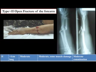 Type~II Open Fracture of the forearm
II >1cm
long
Moderate Moderate, some muscle damage Moderate
comminution
 