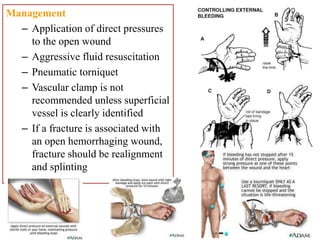 Management
– Application of direct pressures
to the open wound
– Aggressive fluid resuscitation
– Pneumatic torniquet
– Vascular clamp is not
recommended unless superficial
vessel is clearly identified
– If a fracture is associated with
an open hemorrhaging wound,
fracture should be realignment
and splinting
 