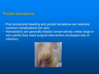 Pocket hematoma
• Post procedural bleeding and pocket hematoma are relatively
common complications (on oac)
• Hematoma’s are generally treated conservatively unless large or
very painful they need surgical intervention (increased rate of
infection)
 