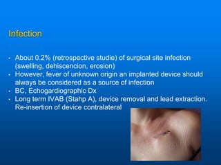 Infection
• About 0.2% (retrospective studie) of surgical site infection
(swelling, dehiscencion, erosion)
• However, fever of unknown origin an implanted device should
always be considered as a source of infection
• BC, Echogardiographic Dx
• Long term IVAB (Stahp A), device removal and lead extraction.
Re-insertion of device contralateral
 
