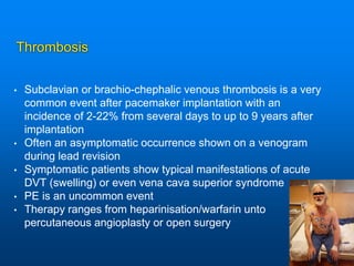 Thrombosis
• Subclavian or brachio-chephalic venous thrombosis is a very
common event after pacemaker implantation with an
incidence of 2-22% from several days to up to 9 years after
implantation
• Often an asymptomatic occurrence shown on a venogram
during lead revision
• Symptomatic patients show typical manifestations of acute
DVT (swelling) or even vena cava superior syndrome
• PE is an uncommon event
• Therapy ranges from heparinisation/warfarin unto
percutaneous angioplasty or open surgery
 