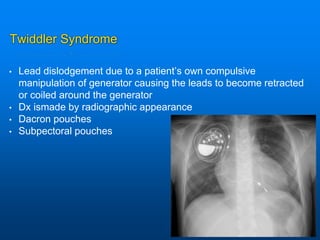 Twiddler Syndrome
• Lead dislodgement due to a patient’s own compulsive
manipulation of generator causing the leads to become retracted
or coiled around the generator
• Dx ismade by radiographic appearance
• Dacron pouches
• Subpectoral pouches
 