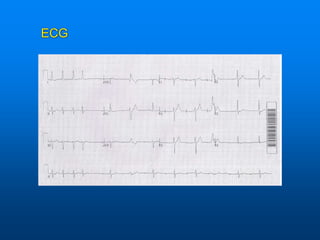 ECG
ECG
 