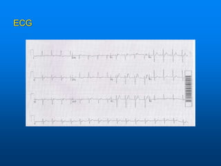 ECG
 