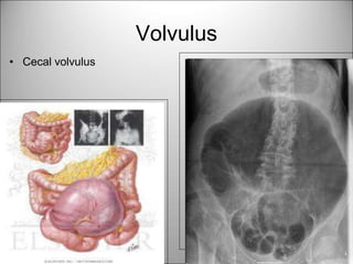 Volvulus Cec Rx Emergency Radiology in Surgery .ppt