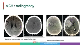 risqi.rakhman@gmail.com
sICH:radiography
Petechialhemorrhageintoareaofinfarction Parenchymalhematome
 