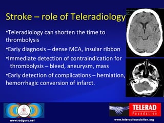 Stroke – role of Teleradiology
•Teleradiology can shorten the time to
thrombolysis
•Early diagnosis – dense MCA, insular ribbon
•Immediate detection of contraindication for
thrombolysis – bleed, aneurysm, mass
•Early detection of complications – herniation,
hemorrhagic conversion of infarct.
 