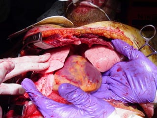  http://www.trauma.org/arch 
ive/atlas/images/clamshell 
04.jpg 
 