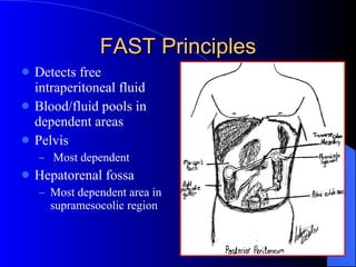 FAST Principles <ul><li>Detects free intraperitoneal fluid </li></ul><ul><li>Blood/fluid pools in dependent areas </li></u...