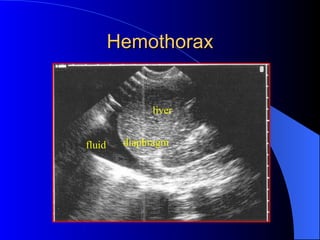 Hemothorax liver diaphragm fluid 