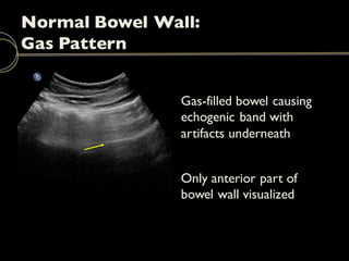 Emergency Ultrasound: Bowel | PDF