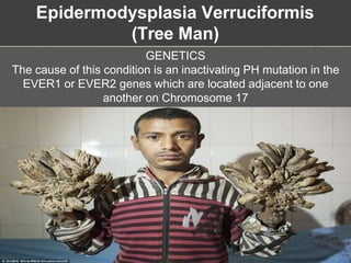 Epidermodysplasia Verruciformis
(Tree Man)
GENETICS
The cause of this condition is an inactivating PH mutation in the
EVER1 or EVER2 genes which are located adjacent to one
another on Chromosome 17
 