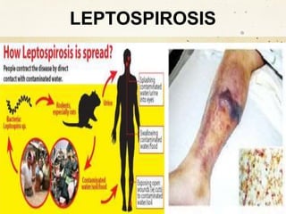 LEPTOSPIROSIS
 