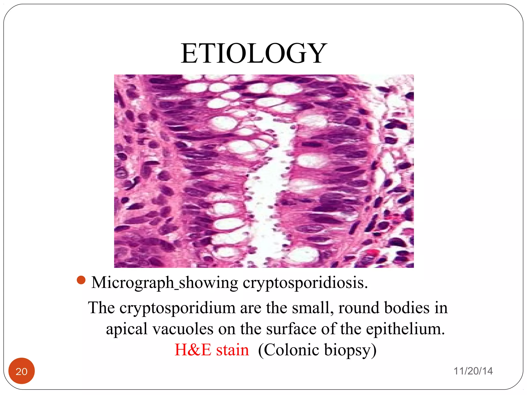 ETIOLOGY 
Micrograph showing cryptosporidiosis. 
The cryptosporidium are the small, round bodies in 
apical vacuoles on the surface of the epithelium. 
H&E stain (Colonic biopsy) 
20 11/20/14 
 