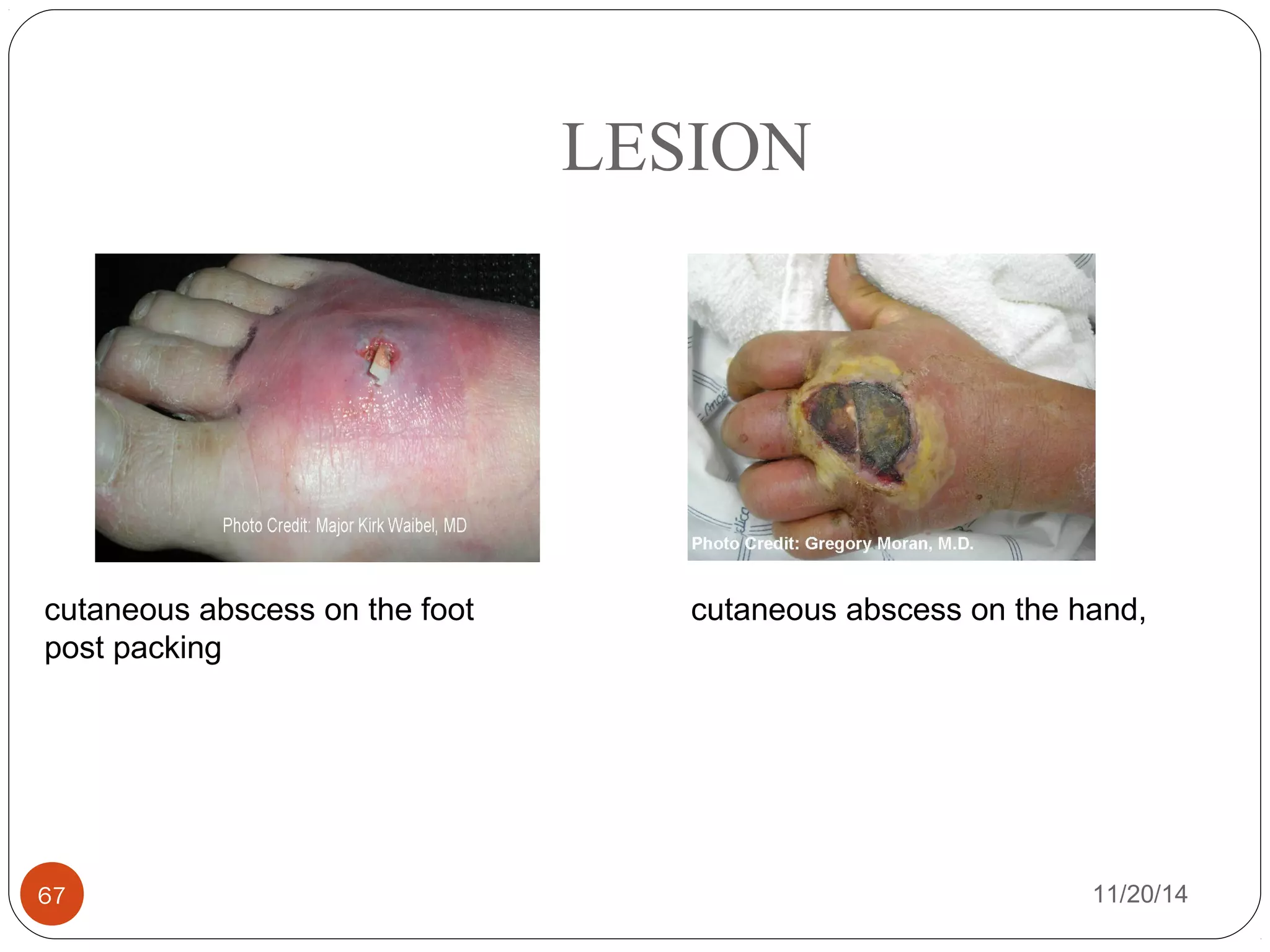 LESION 
cutaneous abscess on the foot 
post packing 
cutaneous abscess on the hand, 
67 11/20/14 
 