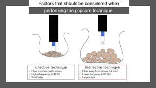 Factors that should be considered when
performing the popcorn technique.
 
