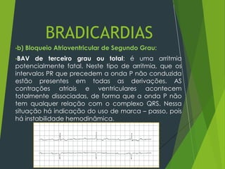 •b) Bloqueio Atrioventricular de Segundo Grau:
•BAV de terceiro grau ou total: é uma arritmia
potencialmente fatal. Neste tipo de arritmia, que os
intervalos PR que precedem a onda P não conduzida
estão presentes em todas as derivações. AS
contrações atriais e ventriculares acontecem
totalmente dissociadas, de forma que a onda P não
tem qualquer relação com o complexo QRS. Nessa
situação há indicação do uso de marca – passo, pois
há instabilidade hemodinâmica.
BRADICARDIAS
 