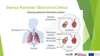 Doença Pulmonar Obstrutiva Crónica
 