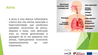 Asma
A asma é uma doença inflamatória
crónica das vias aéreas associada a
hiperreatividade, que condiciona
episódios recorrentes de pieira,
dispneia e tosse, com obstrução
mais ou menos generalizada à
passagem do ar nas pequenas vias
aéreas, habitualmente reversíveis
espontaneamente ou com
tratamento.
 