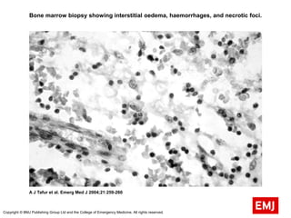 Bone marrow biopsy showing interstitial oedema, haemorrhages, and necrotic foci.
A J Tafur et al. Emerg Med J 2004;21:259-260
Copyright © BMJ Publishing Group Ltd and the College of Emergency Medicine. All rights reserved.
 