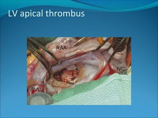 LV apical thrombus
 