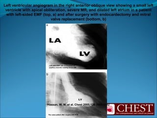 Hassan, W. M. et al. Chest 2005;128:3985-3992
Left ventricular angiogram in the right anterior oblique view showing a small left
ventricle with apical obliteration, severe MR, and dilated left atrium in a patient
with left-sided EMF (top, a) and after surgery with endocardectomy and mitral
valve replacement (bottom, b)
 