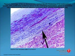 Figure 6. Histology of the LA demonstrates marked fibrotic thickening of the endocardium
(arrow), with proliferation of fibrous tissue in the underlying myocardium, which is consistent
with endomyocardial fibrosis (Masson trichrome stain, original magnification ×50).
Cury R C et al. Circulation 2005;111:e115-e117
Copyright © American Heart Association
 