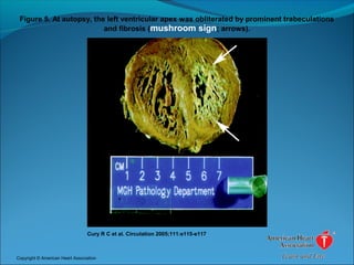 Figure 5. At autopsy, the left ventricular apex was obliterated by prominent trabeculations
and fibrosis (mushroom sign; arrows).
Cury R C et al. Circulation 2005;111:e115-e117
Copyright © American Heart Association
 