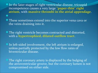 In the later stages of right ventricular disease, tricuspid
incompetence causes a very large "paper-thin" right
atrium, with massive thrombi in the atrial appendage.

These sometimes extend into the superior vena cava or
the veins draining into it.
The right ventricle becomes contracted and distorted,
with a hypertrophied, dilated outflow tract.
In left-sided involvement, the left atrium is enlarged,
unless partially protected by the low flow rates of
biventricular disease.
The right coronary artery is displaced by the bulging of
the atrioventricular groove, but the coronary lumen is not
compromised on either side.
 