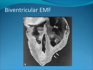 Biventricular EMF
 