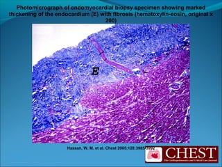 Hassan, W. M. et al. Chest 2005;128:3985-3992
Photomicrograph of endomyocardial biopsy specimen showing marked
thickening of the endocardium (E) with fibrosis (hematoxylin-eosin, original x
200)
 