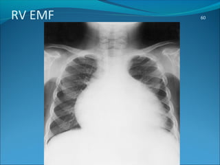 RV EMF 60
 
